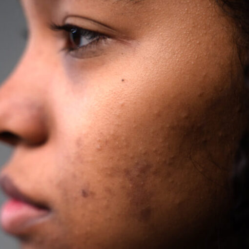 Um close-up de um rosto feminino com hiperpigmentação.